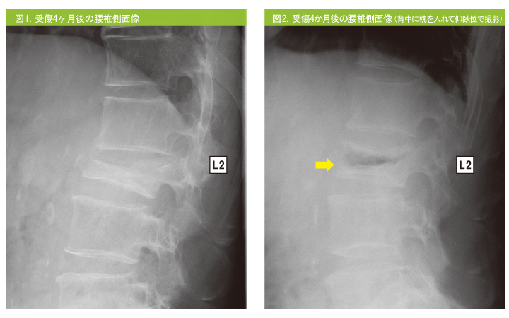 図4．受傷後4ヵ月の腰椎側面像（側臥位で後屈）図5．受傷後4ヵ月の腰椎側面像（仰臥位で後屈）