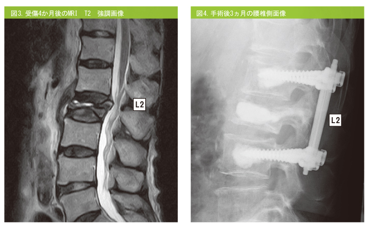 図6．腰椎MRI T２ 強調像図7.手術後2ヵ月の腰椎側面像