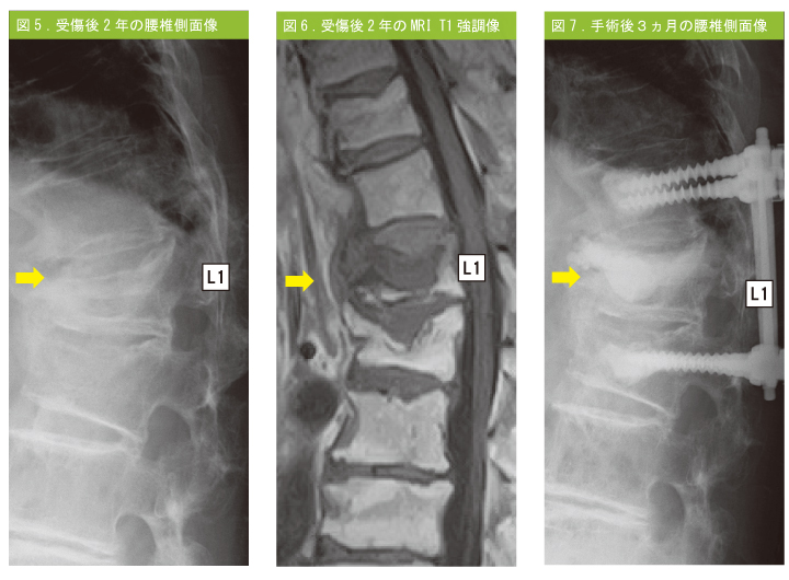 図1.受傷後2 年の腰椎側面像 図2.受傷後2 年のMRI T1 強調像 図3.手術後３ヵ月の腰椎側面像